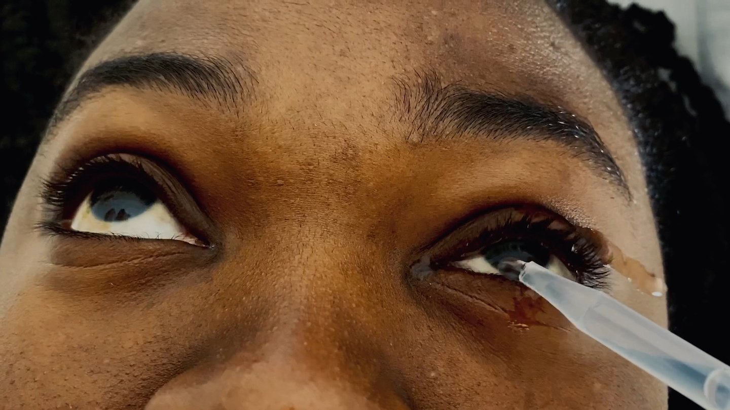 A close-up of a person's face as clear liquid is inserted into their eye with a plastic dropper.